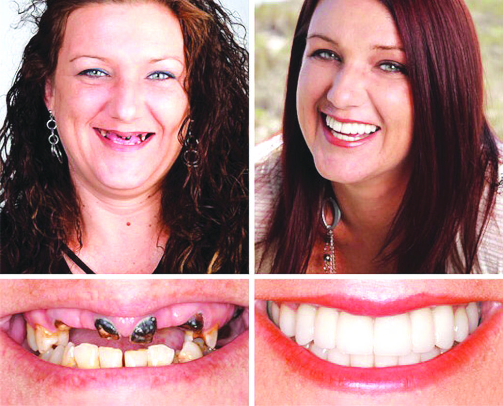 Hình trước và sau khi làm phẫu thuật "All-on-4". (Hình: Pearly Smile Dental cung cấp)