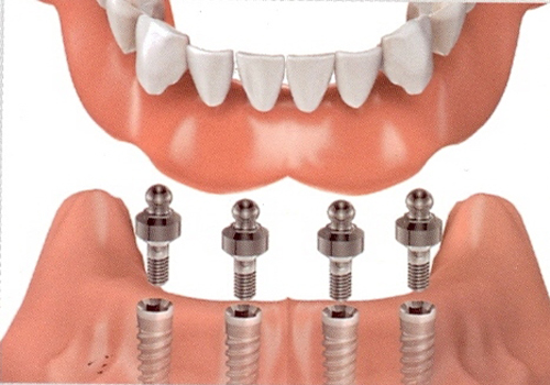 Implant-Nguyên-Hàm-Răng-Dưới.