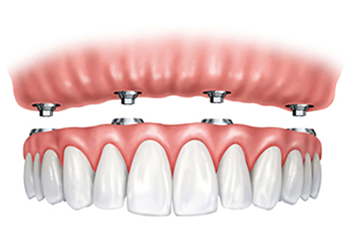 Implant-Nguyên-Hàm-Răng-Trên.