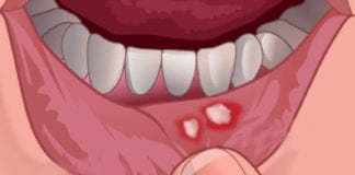 Bệnh lở môi và lợi là một bệnh gây nhiều phiền phức, nhất là về ăn uống. (Hình minh họa: rchsd.org)