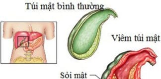 Vị trí và hình ảnh viêm túi mật trong ổ bụng. (Hình: Sức Khỏe & Đời Sống)