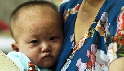 measles vietnam